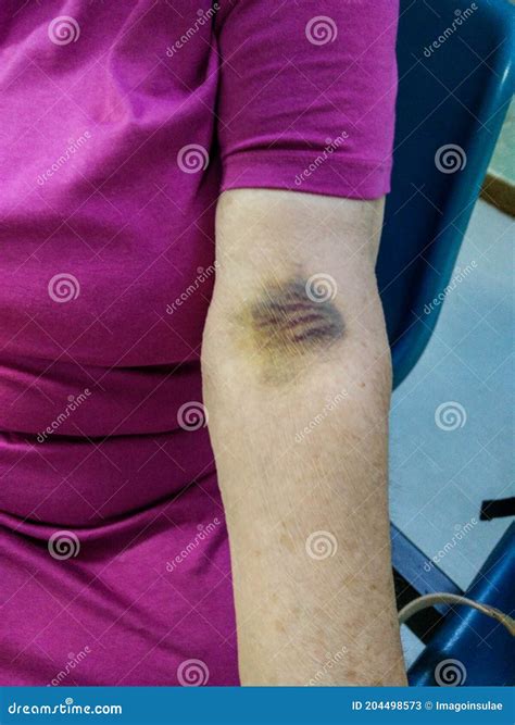 That being said, a rash on your arm after the Moderna shot specifically is. . Hematoma in left arm from meth injection
